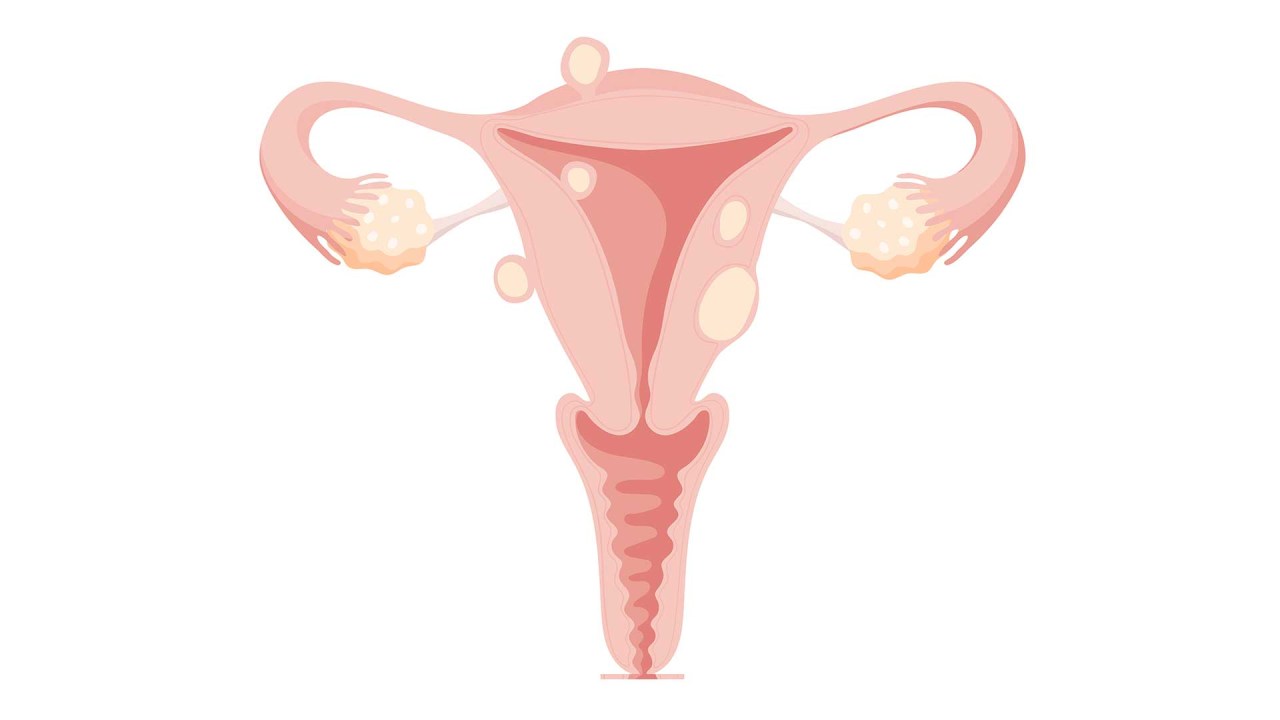 ilustração de um útero com bolinhas que representam miomas